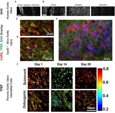 Label-Free Multiphoton Microscopy for the Detection and Monitoring of Calcific Aortic Valve Disease